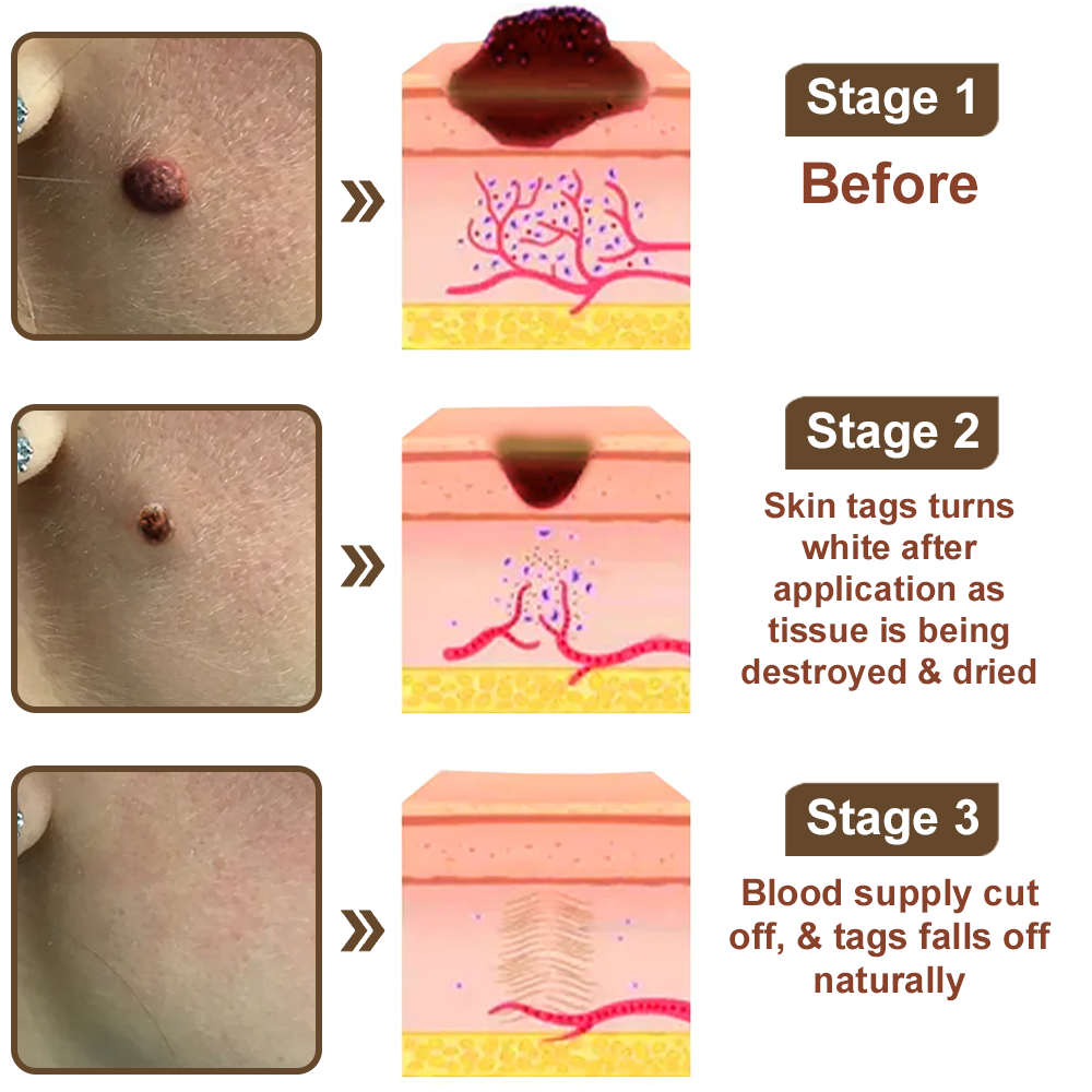 Natravor® Black Rice Skin Repair Essence Cream ⚕️ FDA Certified (Removes warts and skin growths, improves keratin buildup and seborrheic dermatitis, follicular keratosis, age spots, and bruising)